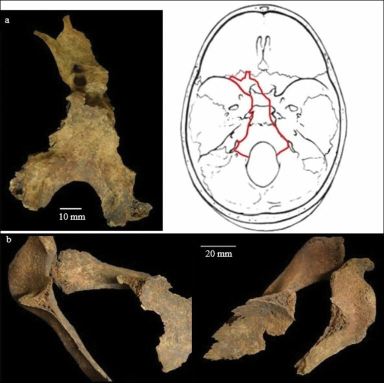Cranial wounds and fractures