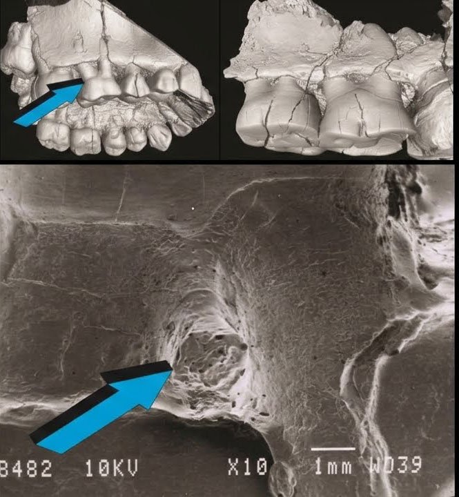 3D virtual reconstruction and SEM reveal horizontal alveolar bone loss in Plio-Pleistocene hominin fossil remains.